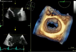 ecocardiografia 3D