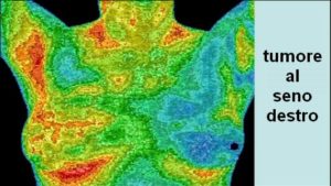 tumore-al-seno-2