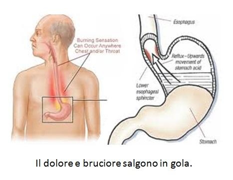 Reflusso gastroesofageo: ecco di cosa si tratta e possibili rimedi