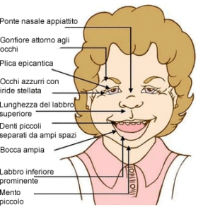 sindrome-di-williams