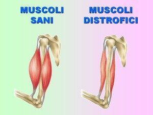 distrofia muscolare