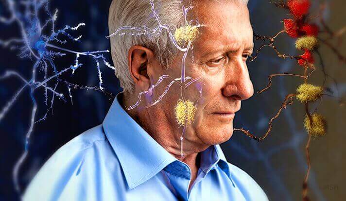 Malattia di Alzheimer, individuato il gene che combatte la malattia