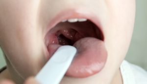 La Tracheite: sintomi e rimedi naturali per il mal di gola