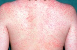 Morbillo a Catania, muore un bimbo di 10 mesi