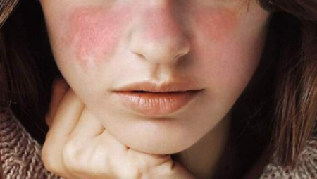 Lupus Eritematoso Sistemico, terapie e consigli utili