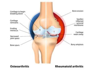Artrite reumatoide: I fattori a rischio e l'accesso alle terapie