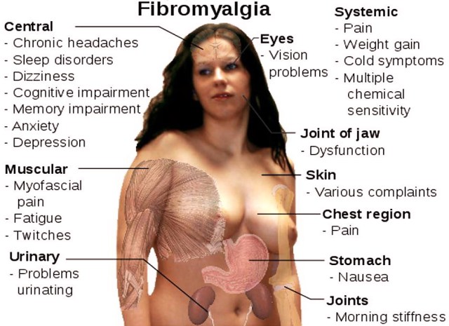 Fibromialgia, una malattia fantasma: Sintomi, cause e terapie