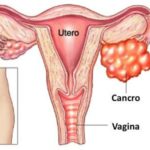 Tumore ovarico di oltre 50 chili operato in India