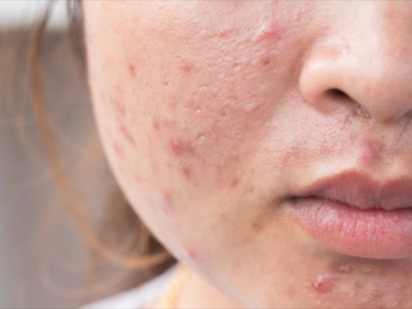 'Sos acne', nuove cure e assistenza per la malattia cronica