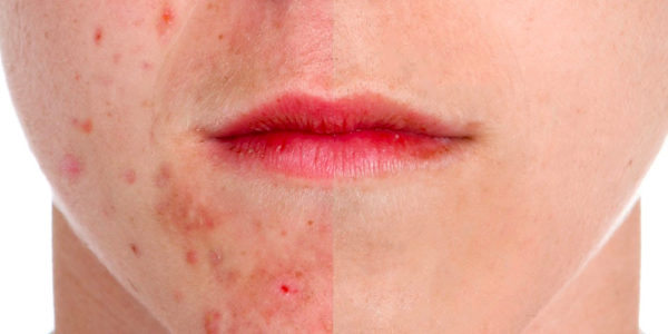 'Sos acne', nuove cure e assistenza per la malattia cronica
