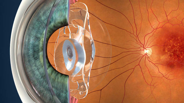 Maculopatia, retina artificiale impiantata su 5 pazienti non vedenti