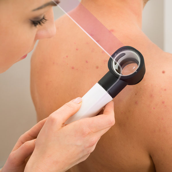 'Sos acne', nuove cure e assistenza per la malattia cronica