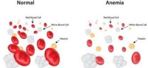 Talassemia: in Italia oltre 6mila pazienti. Arriva la prima formazione sulle Emoglobinopatie