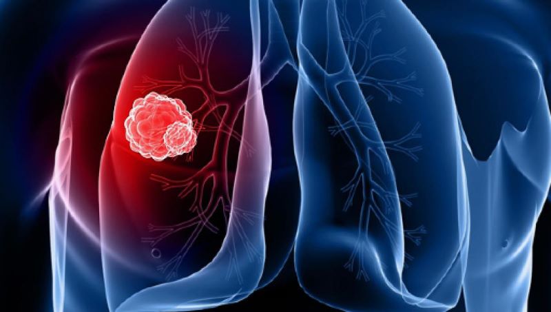 Cancro ai polmoni: nuovo farmaco cala dell’80% i rischi di ricaduta